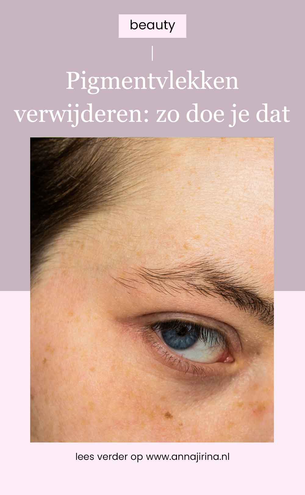pigmentvlekken verwijderen: zo doe je dat | Pigmentvlekken verwijderen op een natuurlijke manier
