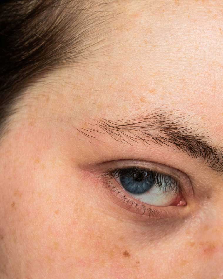 Pigmentvlekken verwijderen op een natuurlijke manier: 5 Wonder middelen